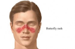 Lupus Butterfly Rash on Face