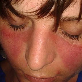 Lupus Symptoms from Sunlight