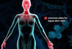 what causes lupus